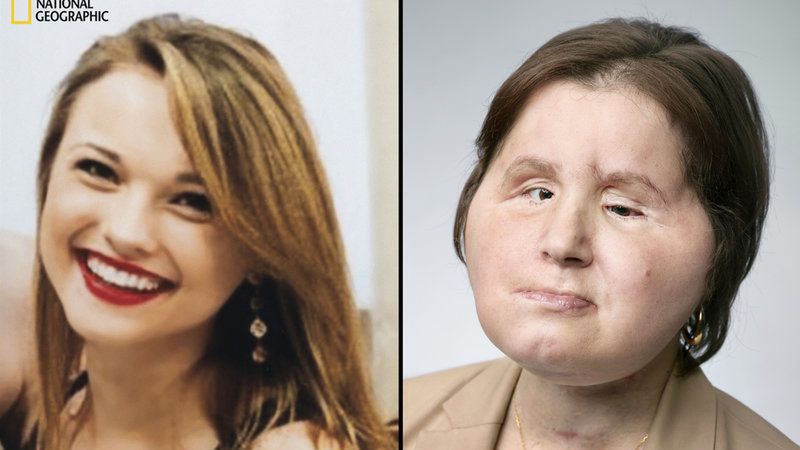 Wygląd Katie przed przeszczepem i po