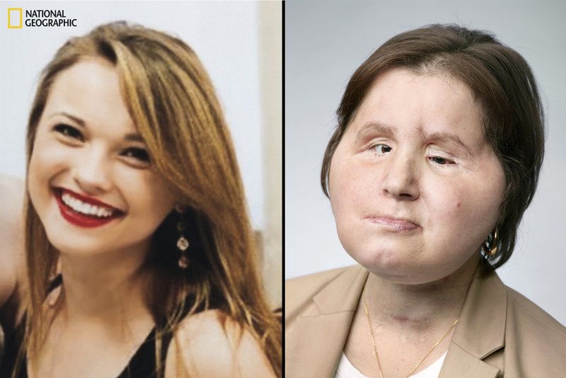 Wygląd Katie przed przeszczepem i po