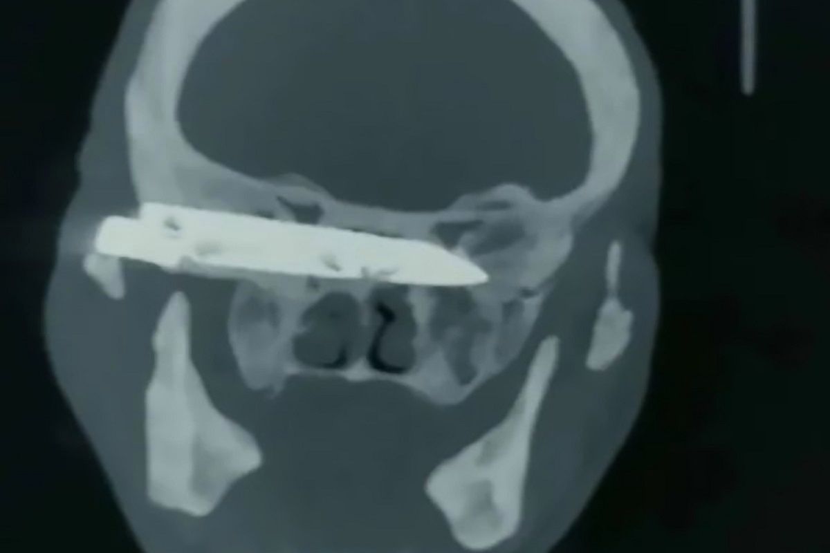 W latach 90. mężczyzna został dźgnięty nożem w głowie. Po 26 latach lekarze postanowili przeprowadzić zabieg.