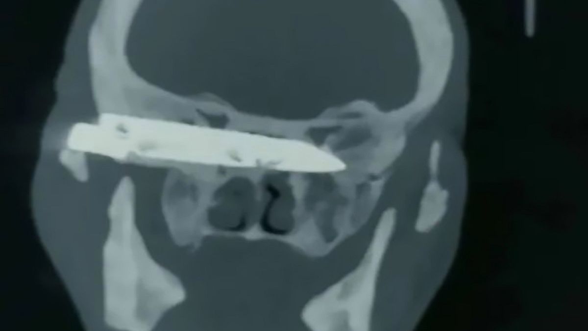 W latach 90. mężczyzna został dźgnięty nożem w głowie. Po 26 latach lekarze postanowili przeprowadzić zabieg.