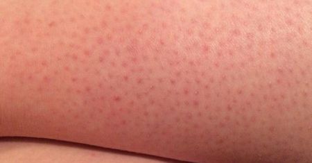 Sprawdź, skąd takie kropki biorą się na twoich nogach