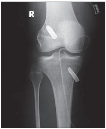 Migracja piszczelowej śruby interferencyjnej po rekonstrukcji ACL