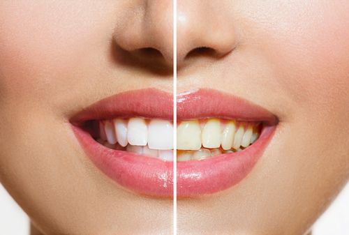 Smile makeover – całkowita zmiana wyglądu zębów