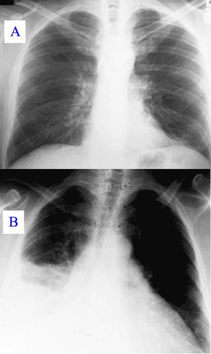 Porównanie zdjęcia płuc zdrowych i z zapaleniem płuc 