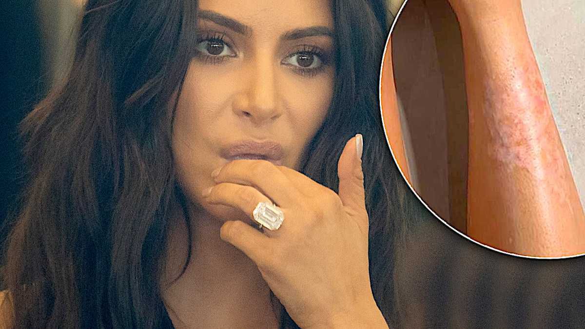 Kim Kardashian od lat choruje na łuszczycę! Po raz pierwszy pokazała zmiany na swojej skórze. Zdradziła, jak musi je ukrywać podczas oficjalnych wyjść