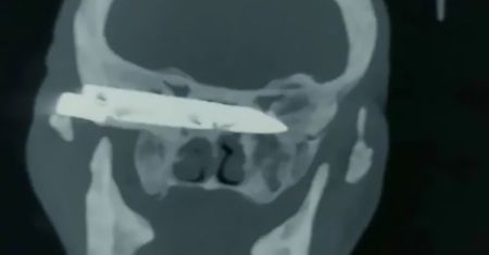 Chiny. Lekarze usunęli nóż z głowy mężczyzny, który żył z nim przez 26 lat