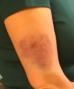 Dziennikarka Agnieszka Romaszewska-Guzy była gościem TVN24. Po wyjściu ze studia pokazała siniaka