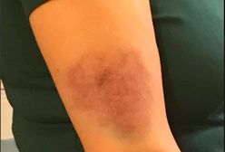 Dziennikarka Agnieszka Romaszewska-Guzy była gościem TVN24. Po wyjściu ze studia pokazała siniaka