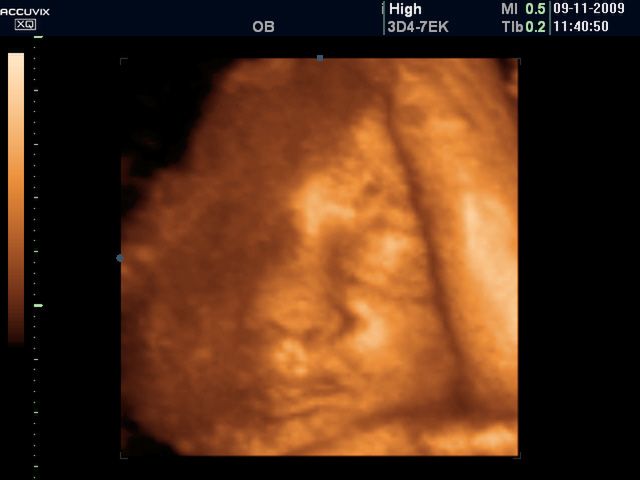 Płód w 40 tygodniu ciąży (zdjęcia 3D)