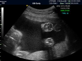Płód w 26 tygodniu ciąży (zdjęcia 3D)