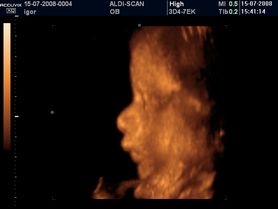 Płód w 34 tygodniu ciąży (zdjęcia 3D)