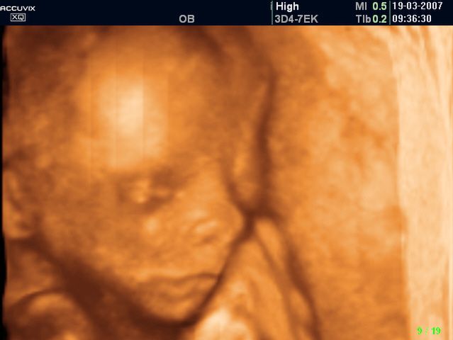 Twarz dziecka na USG w 18 tygodniu ciąży 