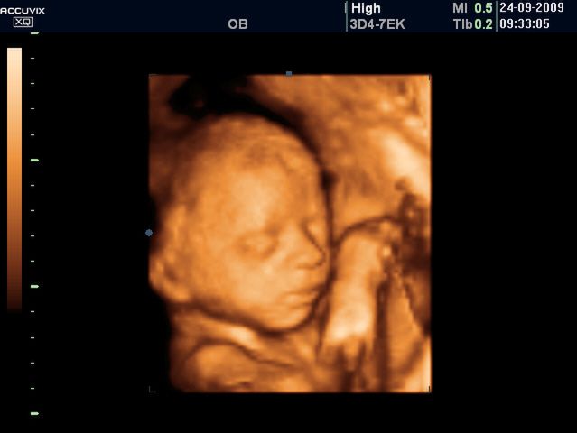Płód w 26 tygodniu ciąży - ssanie palca 