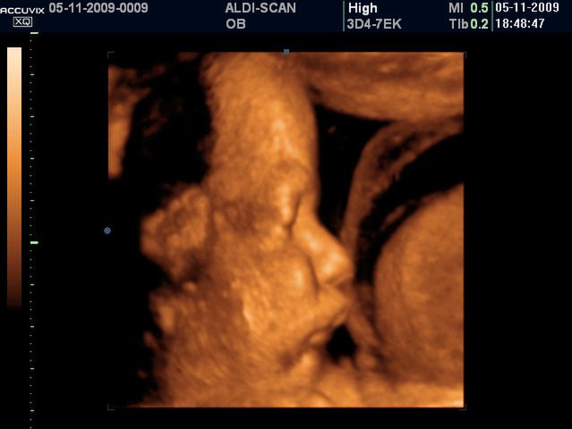 USG 3D w 30 tygodniu ciąży 