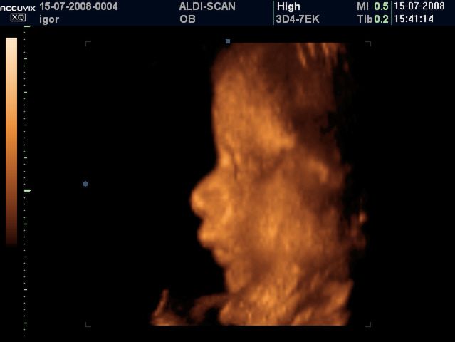 Płód w 34 tygodniu ciąży - obraz USG