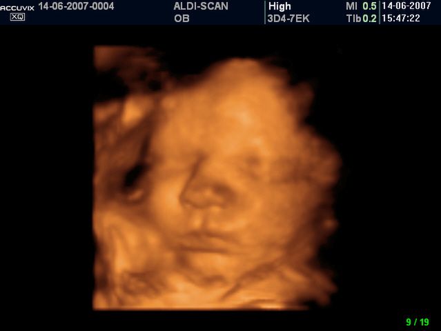 Płód w 34 tygodniu ciąży - twarz dziecka 