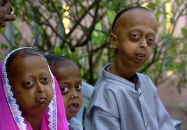 Jest lek na progerię i starość?