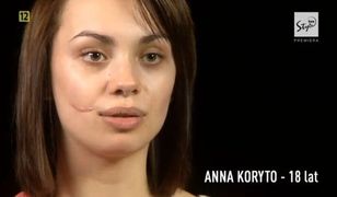 Anna Koryto na operacyjnym stole! Bliznę usunięto jej w "Sekretach chirurgii"!