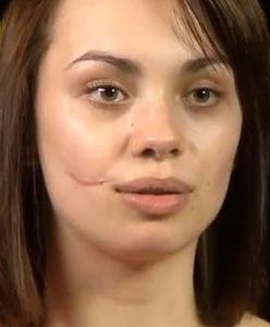 Anna Koryto na operacyjnym stole! Bliznę usunięto jej w "Sekretach chirurgii"!