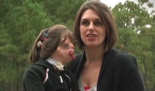 Przez całe życie słyszy, że nie powinna się urodzić. Rodzice "dziewczynki bez twarzy" uczą się od niej miłości