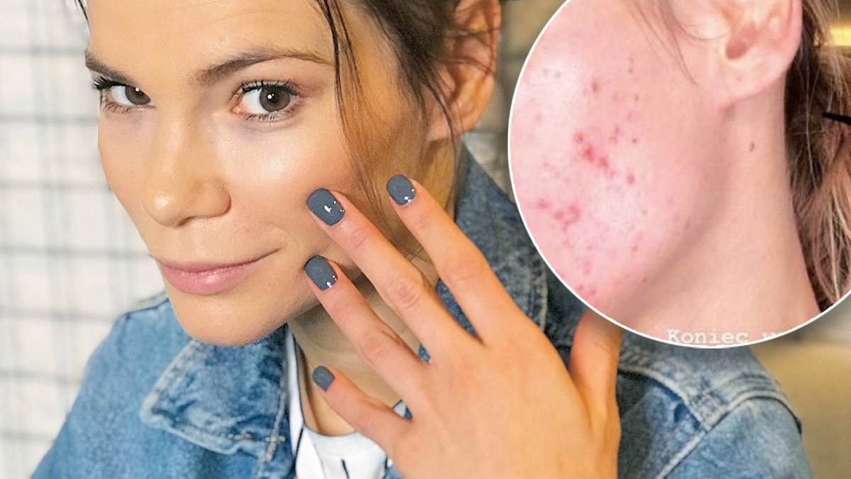 Maja Bohosiewicz pod grubą warstwą makijażu ukrywała trądzik. Teraz pokazała, jak naprawdę wyglądała jej twarz
