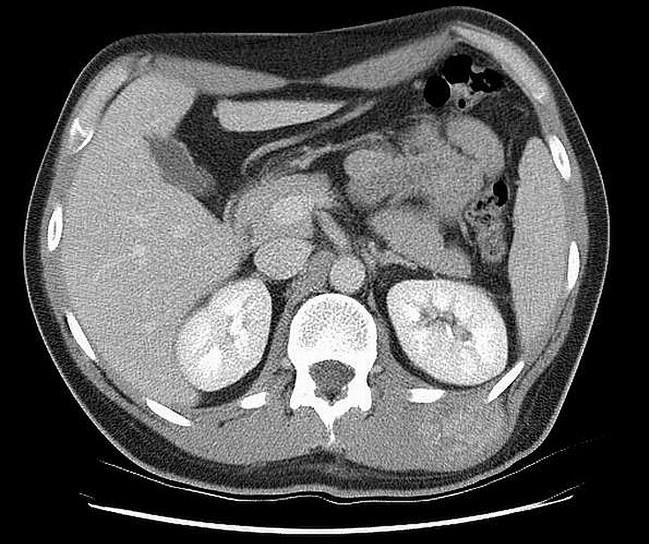 Operacja usunięcia guza tkanek miękkich (prezentacja edukacyjna)