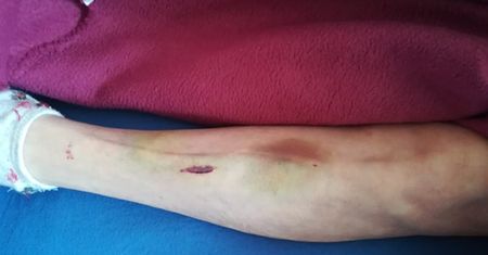 79-letnia kobieta miała zostać pobita przez opiekunkę. "Zrobiła z mojej mamy kalekę"