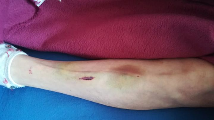 79-letnia Joanna Zgiet została silnie poturbowana