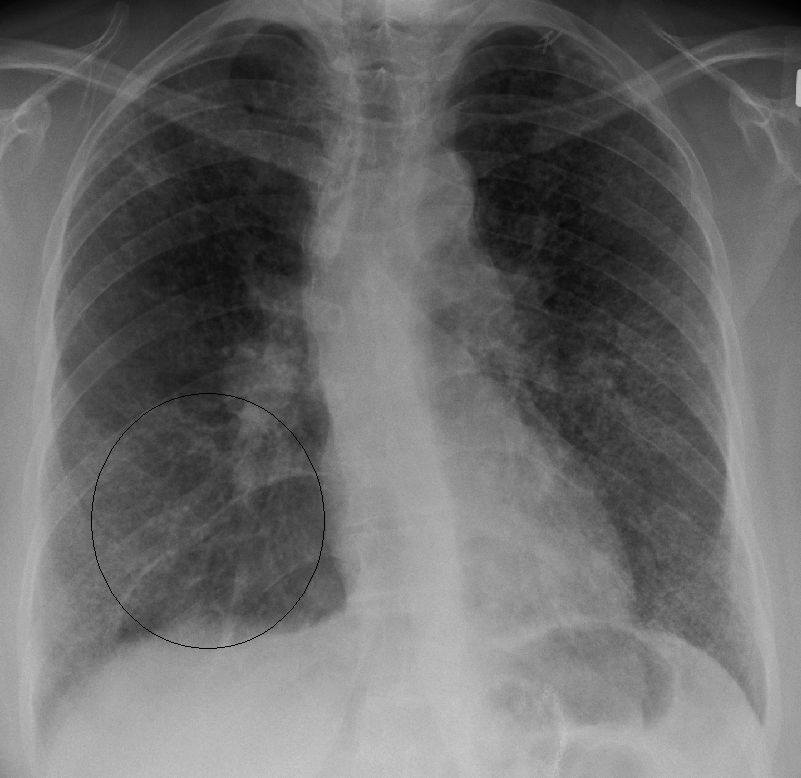 Zdjęcie RTG płuc z sarkoidozą 