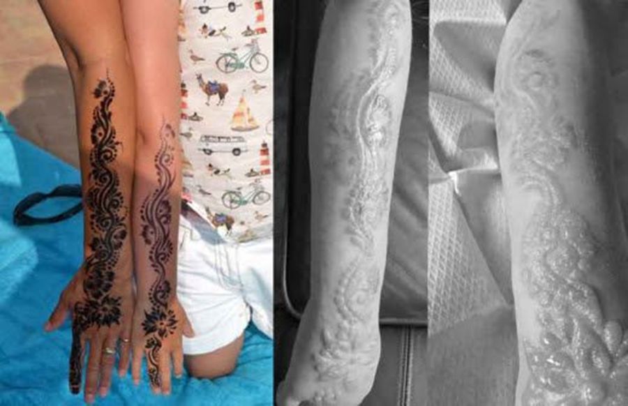 7-latka przeżywa śmiertelny ból. Zrobiła tatuaż z henny na wakacjach w Egipcie