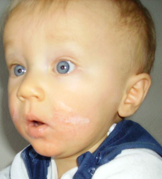 Ślady alergii na skórze dziecka 