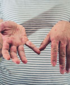 Kolejne ognisko odry pod Warszawą. Piastów choruje