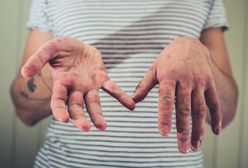 Kolejne ognisko odry pod Warszawą. Piastów choruje