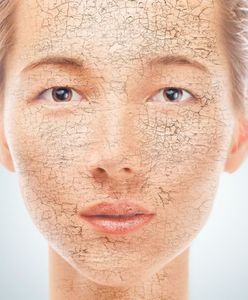 Suche skórki na twarzy i nosie - jak się ich pozbyć?