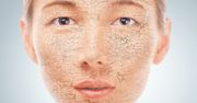 Suche skórki na twarzy i nosie - jak się ich pozbyć?