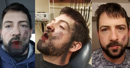 E-papieros eksplodował mu w ustach. Stracił 7 zębów