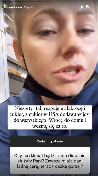 Agata Rubik o problemach z cerą