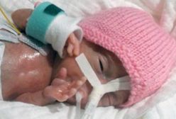 Emilia Grabarczyk to najmniejsze dziecko na świecie! Lekarze nie dawali jej szans na przeżycie