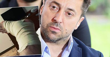 Marcin Miller pokazał, jak wygląda jego stopa po zdjęciu bandaży. Zdjęcie dla osób o mocnych nerwach