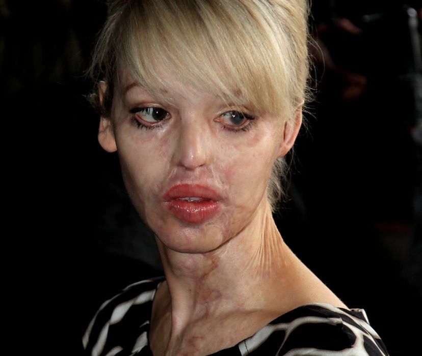 Katie Piper została zgwałcona, więziona i oblana kwasem. Błagała matkę, by ją zabiła