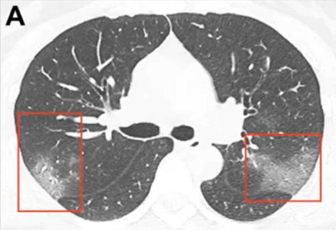 Chiny. Oto jak wirus z Wuhan wpływa na płuca. Lekarze opublikowali szokujące zdjęcie