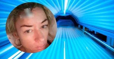 Uzależnienie od solarium. Została oszpecona, teraz apeluje do innych