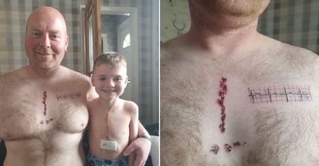 Chciał wesprzeć syna po operacji. Wytatuował sobie bliznę