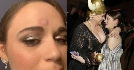 Złote Globy 2020. Joey King dostała statuetką w czoło od  Patricii Arquette! Pochwaliła się... siniakiem