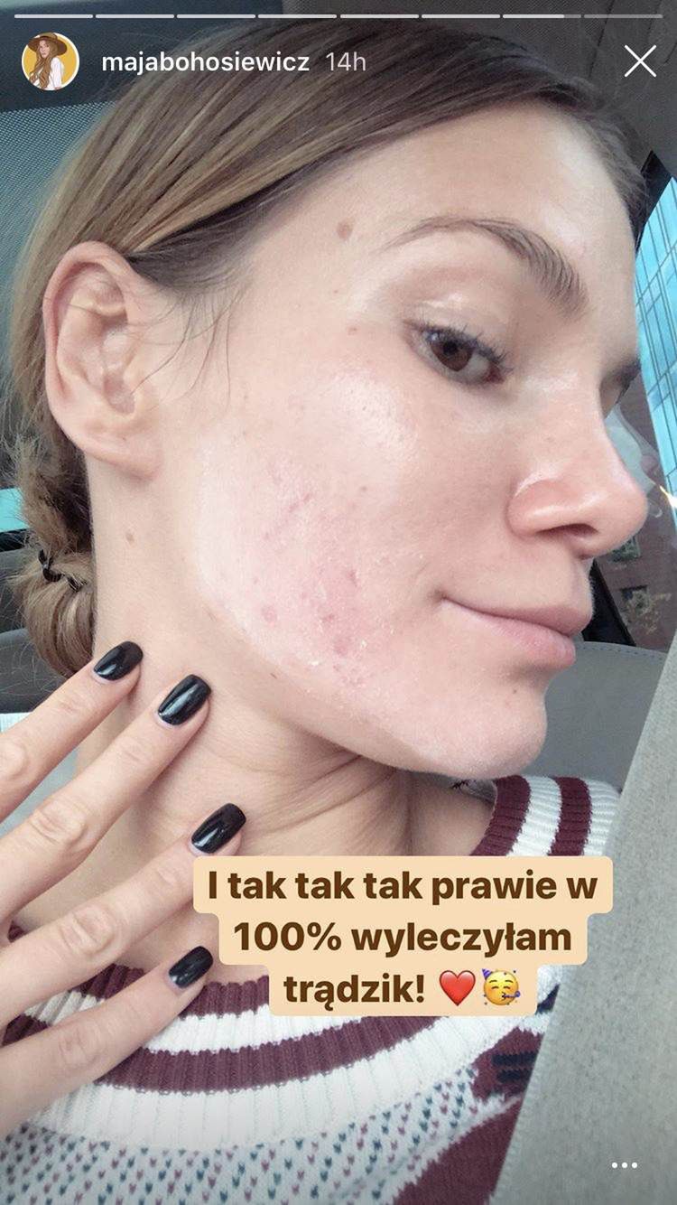 Maja Bohosiewicz pokazała trądzik na twarzy