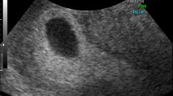 Płód w 9 tygodniu ciąży (bliźniaki jednokosmówkowe) -zdjęcia