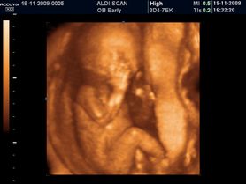 Płód w 11 tygodniu ciąży (zdjęcia 3D)