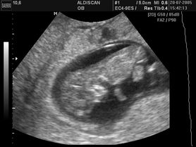 Płód w 10 tygodniu ciąży (zdjęcia)