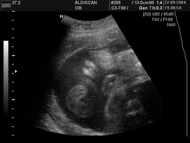 Płód w 27 tygodniu ciąży - obraz USG 