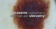 Czerniak. Jak się przed nim chronić?